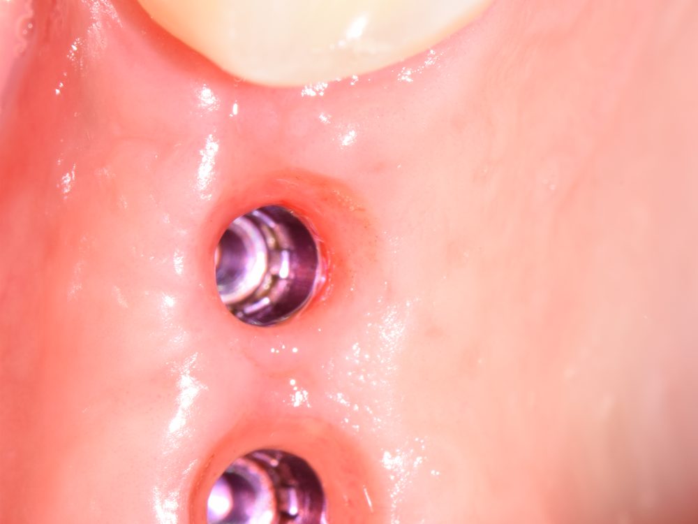 Implantes integrados vistos desde arriba, antes de las coronas