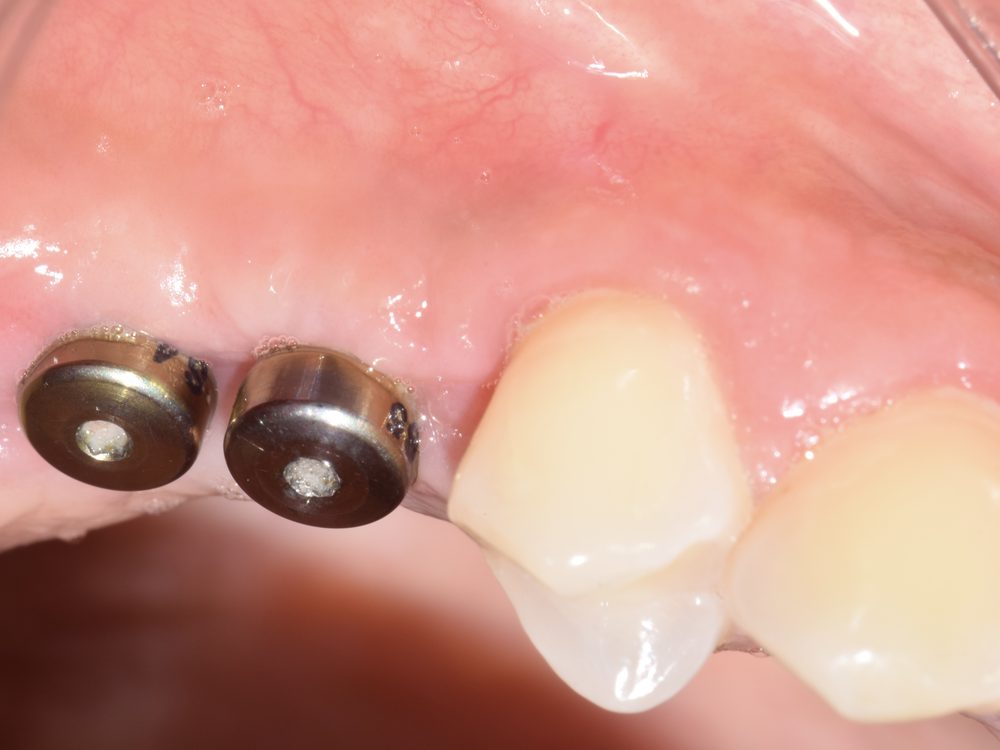 Implantes con sus pilares colocados, vista lateral, antes de las coronas