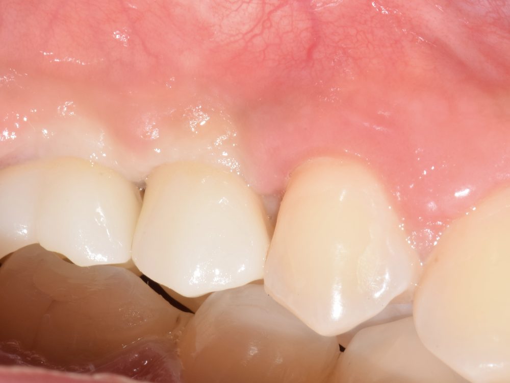 Coronas definitivas sobre los implantes, vista lateral